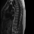 Normal cervical and thoracic spine MRI (Radiopaedia 35630-37156 I 9).png
