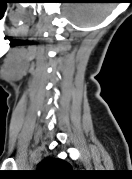 File:Normal cervical spine MRI (including Dixon) (Radiopaedia 42762-45926 C 14).png