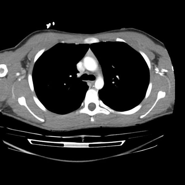 File:Normal dual-phase trauma CT chest,abdomen and pelvis (Radiopaedia 48092-52899 A 19).jpg