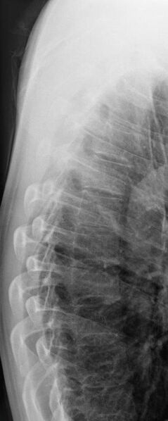 File:Normal lateral thoracic spine radiograph (Radiopaedia 47388).jpg