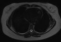 Normal liver MRI with Gadolinium (Radiopaedia 58913-66163 E 33).jpg