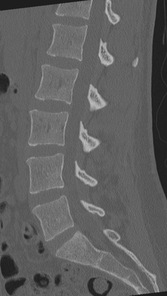 File:Normal lumbar spine CT (Radiopaedia 46533-50986 Sagittal bone window 56).png