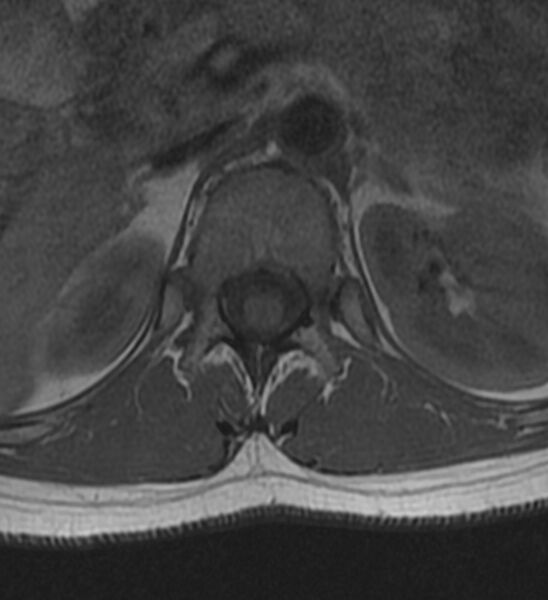 File:Normal thoracic spine MRI (Radiopaedia 41033-43781 Axial T1 29).jpg