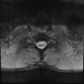 Normal trauma cervical spine (Radiopaedia 41017-43762 Axial T2 24).png