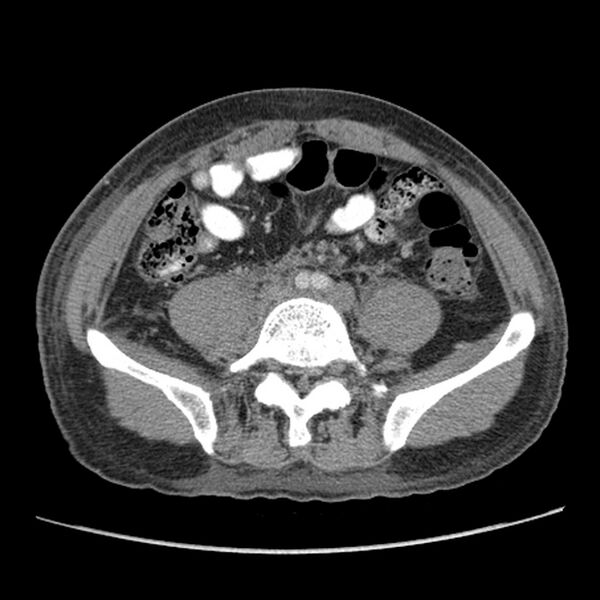 File:Obstructive bladder transitional cell carcinoma (Radiopaedia 9825-10410 A 19).jpg