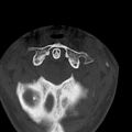 Occipital condyle fracture (Radiopaedia 31755-32691 Axial bone window 12).jpg