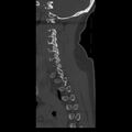 Occipital condyle fracture (Radiopaedia 31755-32691 Sagittal bone window 31).jpg
