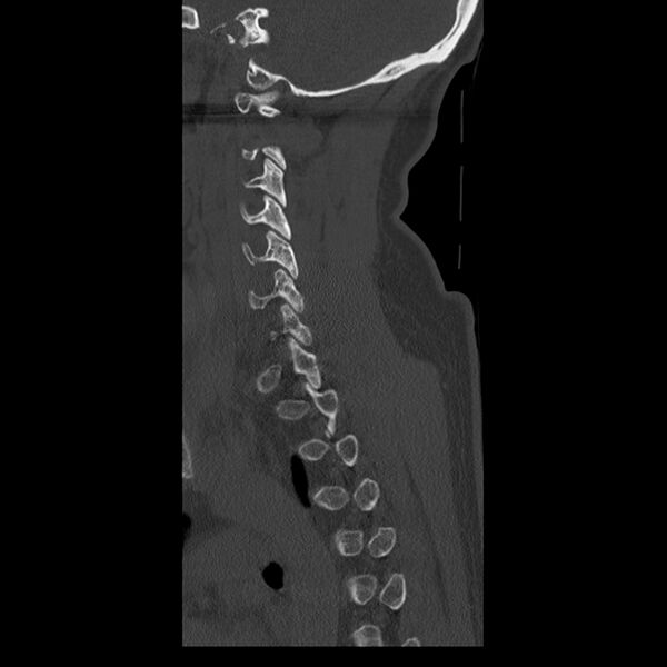 File:Occipital condyle fracture (Radiopaedia 31755-32691 Sagittal bone window 31).jpg