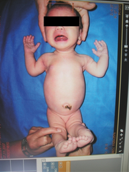Typical hyperextension deformity, mid-face hypoplasia
