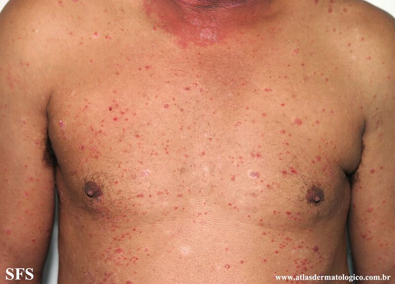 File:Psoriasis (Dermatology Atlas 118).jpg