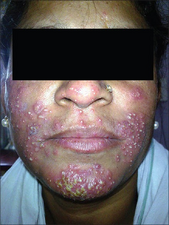 Steroid-induced acne