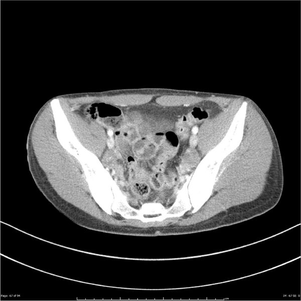 File:Traumatic renal artery dissection and pancreatic transection (Radiopaedia 37061-38739 Axial 244).jpg