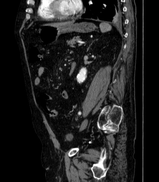 File:Abdominal aortic aneurysm (Radiopaedia 25855-26001 Sagittal C+ arterial phase 44).jpg