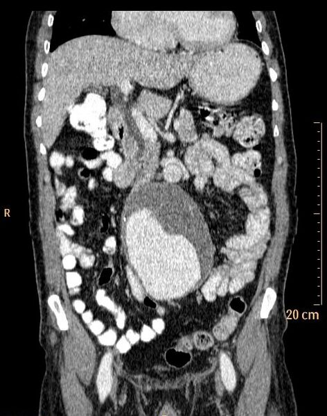 File:Abdominal aortic aneurysm (Radiopaedia 25985-26121 Coronal C+ arterial phase 12).jpg