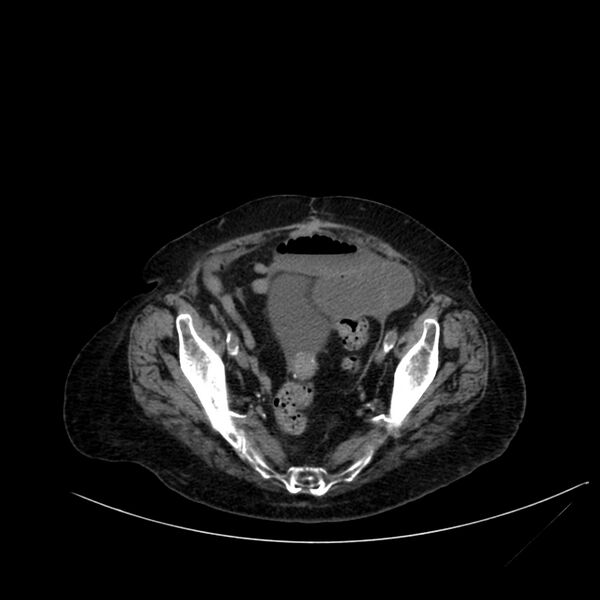 File:Abdominal aortic aneurysm - impending rupture (Radiopaedia 19233-19246 Axial non-contrast 104).jpg
