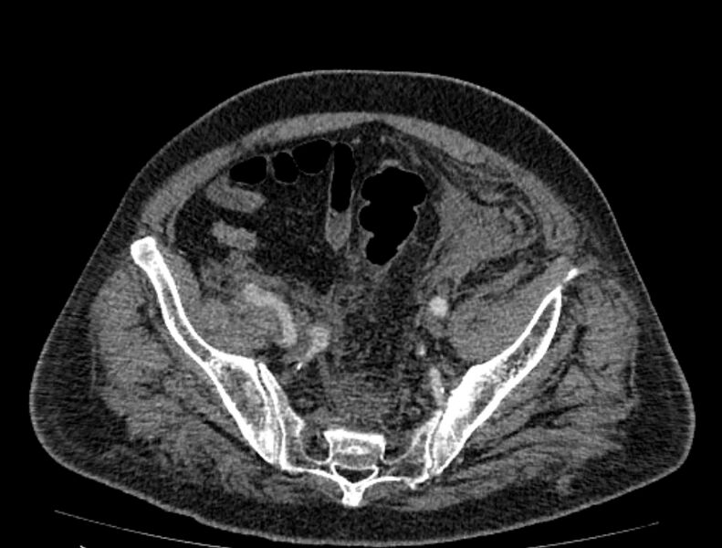 File:Abdominal aortic aneurysm rupture (Radiopaedia 54179-60362 Axial C+ arterial phase 47).jpg