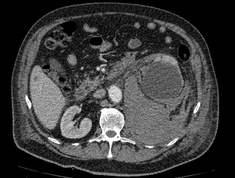 File:Abdominal aortic aneurysm rupture (Radiopaedia 54179-60362 Axial C+ portal venous phase 24).jpg