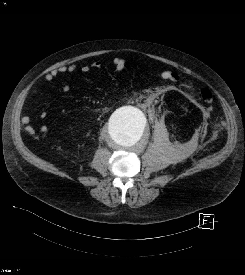 Abdominal aortic aneurysm with intramural hematoma then rupture (Radiopaedia 50278-55632 Axial C+ arterial phase 104).jpg