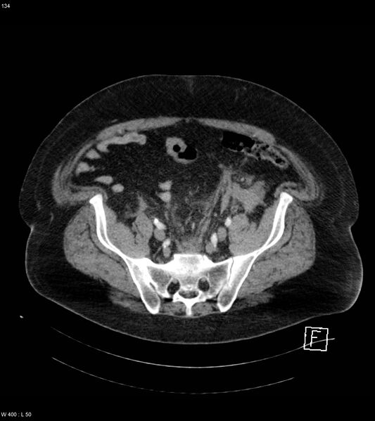 File:Abdominal aortic aneurysm with intramural hematoma then rupture (Radiopaedia 50278-55632 Axial C+ arterial phase 133).jpg