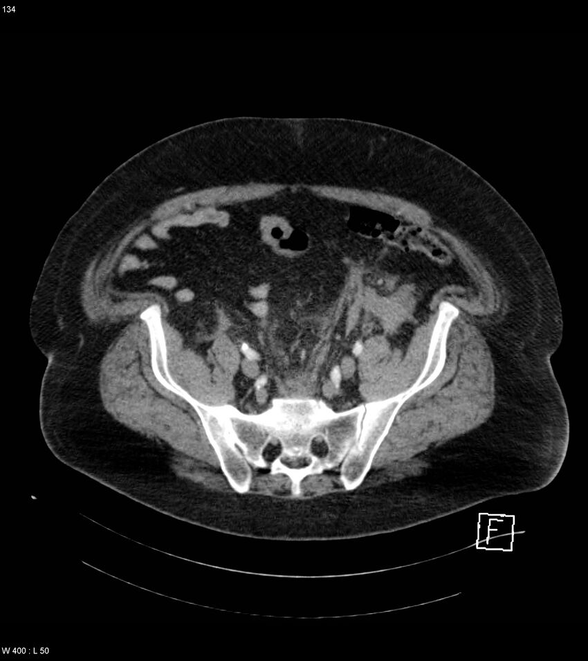 Abdominal aortic aneurysm with intramural hematoma then rupture (Radiopaedia 50278-55632 Axial C+ arterial phase 133).jpg