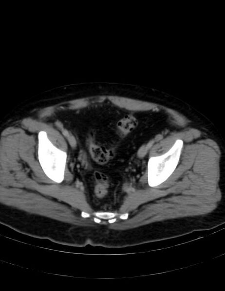 File:Abdominal lymphoma - with sandwich sign (Radiopaedia 53486-59492 Axial C+ portal venous phase 44).jpg
