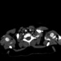 Aberrant left pulmonary artery (pulmonary sling) (Radiopaedia 42323-45435 Axial C+ CTPA 4).jpg