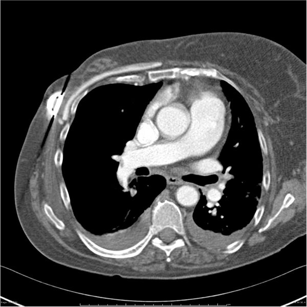 File:Acute-on-chronic pulmonary emboli (Radiopaedia 27925-28169 C+ CTPA 39).jpg