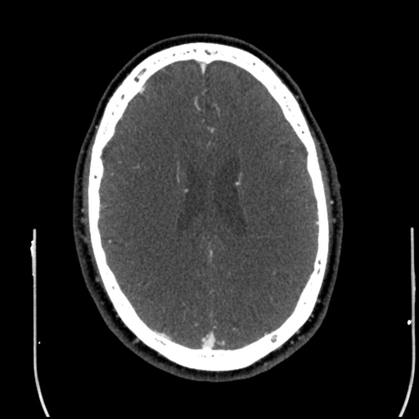 Acute A3 occlusion with ACA ischemic penumbra (CT perfusion) (Radiopaedia 72036-82527 Axial C+ arterial phase thins 32).jpg