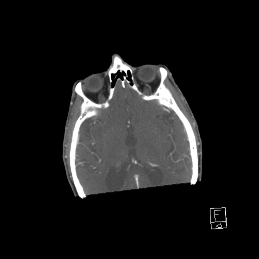 Acute ICA ischemic penumbra due to high-grade CCA stenosis (CT perfusion) (Radiopaedia 72038-82530 Axial C+ arterial phase 3).jpg