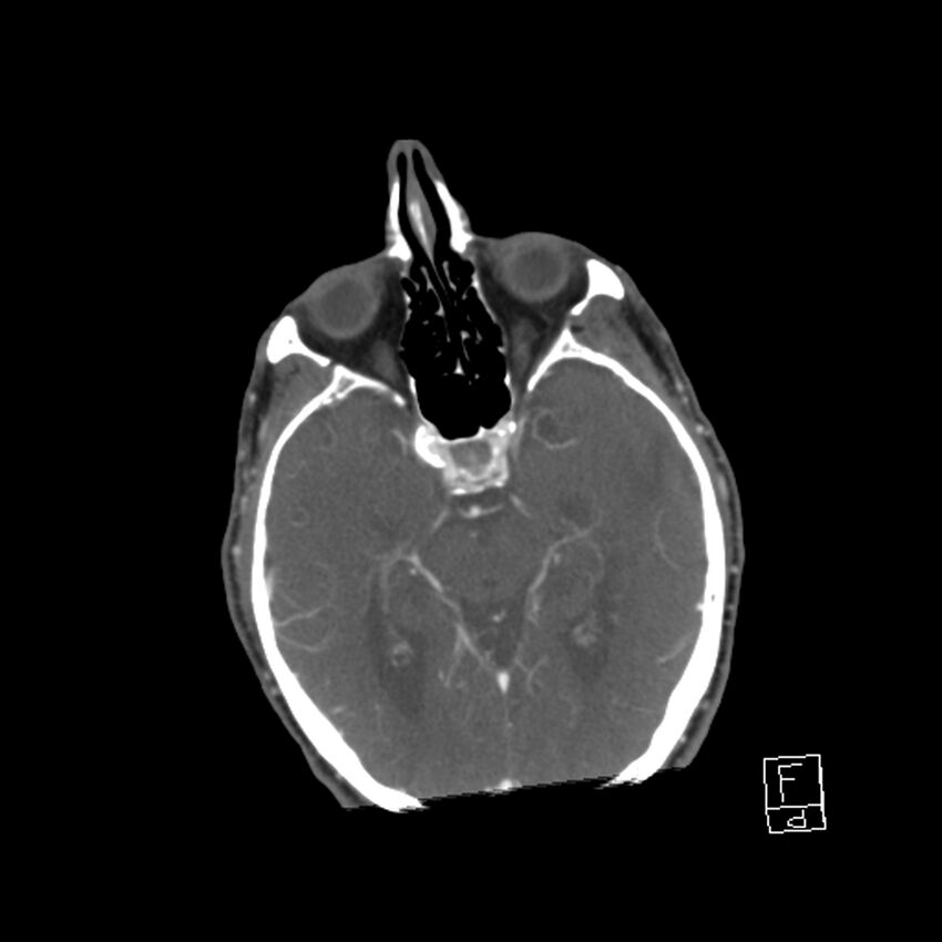 Acute ICA ischemic penumbra due to high-grade CCA stenosis (CT perfusion) (Radiopaedia 72038-82530 Axial C+ arterial phase 8).jpg