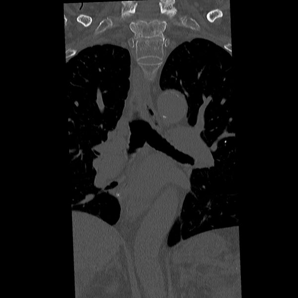 File:Acute and chronic vertebral compression fractures (Radiopaedia 31608-32494 Coronal bone window 7).jpg