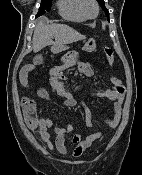 File:Acute appendicitis (Radiopaedia 58627-65818 Coronal non-contrast 30).jpg