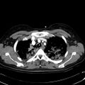 Acute myocardial infarction in CT (Radiopaedia 39947-42415 Axial C+ arterial phase 29).jpg