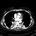 Acute myocardial infarction in CT (Radiopaedia 39947-42415 Axial C+ arterial phase 78).jpg