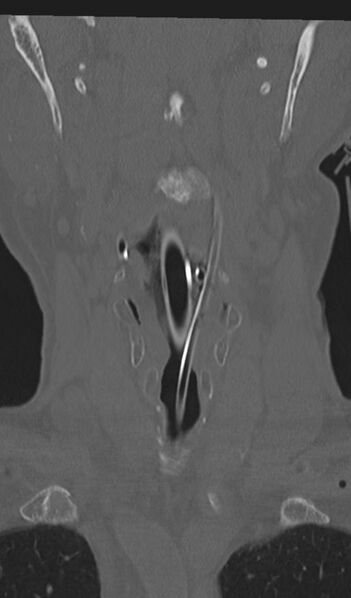 File:Acute on chronic subdural hematoma and thoracic vertebral injury in a multitrauma patient (Radiopaedia 31698-32619 Coronal bone window 6).jpg
