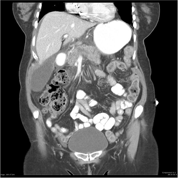 File:Acute pancreatitis (Radiopaedia 19136-19117 Coronal C+ portal venous phase 13).jpg