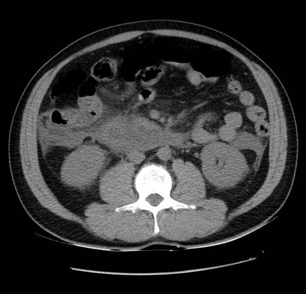 File:Acute pancreatitis - Balthazar E (Radiopaedia 23080-23110 Axial non-contrast 35).jpg