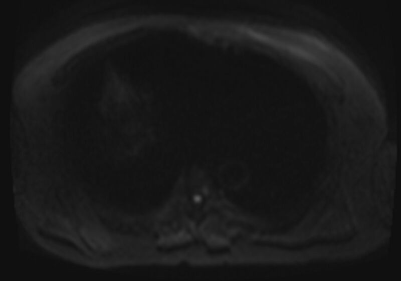 File:Acute portal vein thrombosis (Radiopaedia 73198-83925 Axial DWI 33).jpg