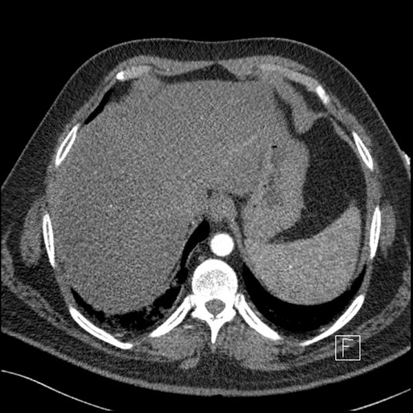 File:Acute pulmonary embolism with pulmonary infarct (Radiopaedia 73062-83768 Axial C+ CTPA 68).jpg