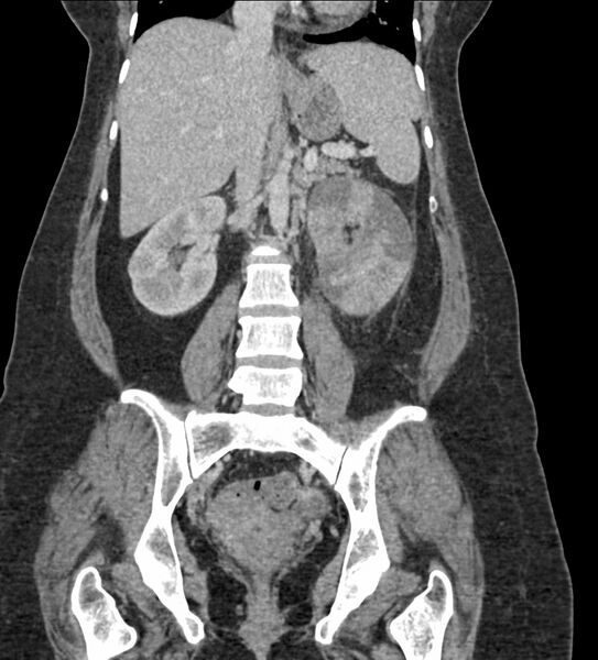File:Acute pyelonephritis with renal vein thrombosis (Radiopaedia 58020-65053 Coronal renal parenchymal phase 57).jpg