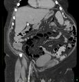 Acute renal failure post IV contrast injection- CT findings (Radiopaedia 47815-52559 Coronal C+ portal venous phase 4).jpg