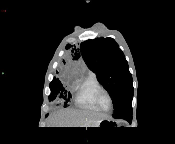 File:Acute right lung abscess (Radiopaedia 34806-36258 Coronal C+ arterial phase 47).jpg