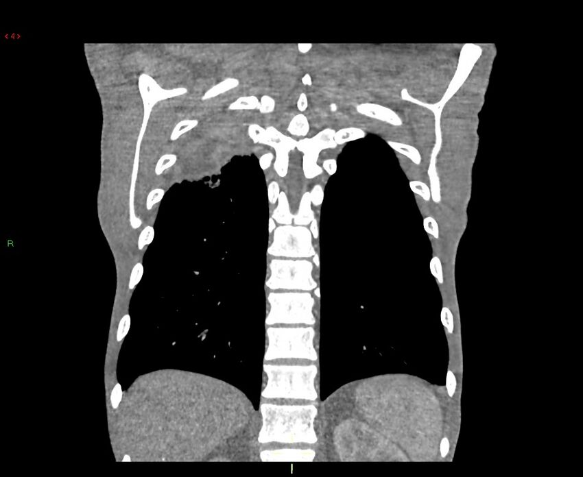Acute right lung abscess (Radiopaedia 34806-36258 Coronal C+ arterial phase 9).jpg