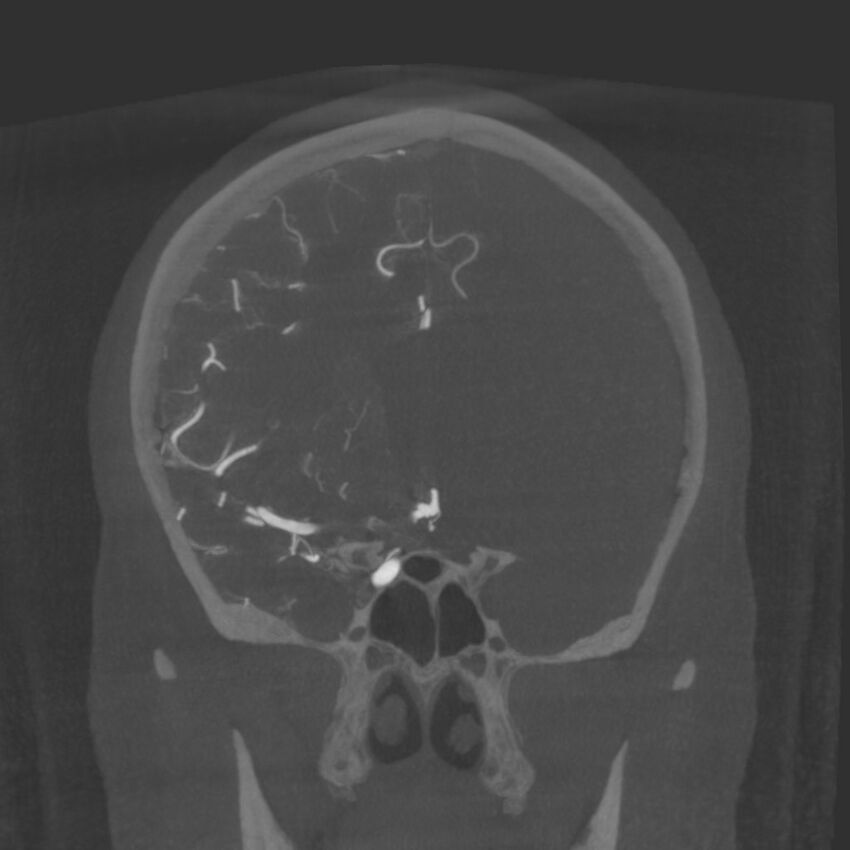 Acute subarachnoid hemorrhage and accessory anterior cerebral artery (Radiopaedia 69231-79010 Coronal arterial - MIP 39).jpg
