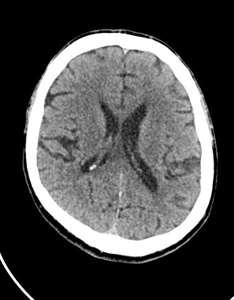File:Acute superior cerebellar artery territory infarct (Radiopaedia 84104-99359 Axial non-contrast 31).jpg