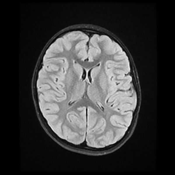 File:Adamantinomatous craniopharyngioma (Radiopaedia 77407-89529 Axial FLAIR 15).jpg