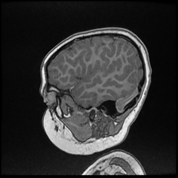 File:Adamantinomatous craniopharyngioma (Radiopaedia 77407-89529 Sagittal T1 C+ 25).jpg