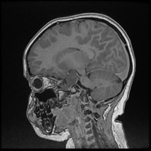 File:Adamantinomatous craniopharyngioma (Radiopaedia 77407-89529 Sagittal T1 C+ 80).jpg