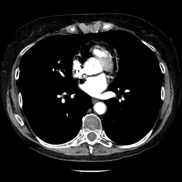 File:Adenocarcinoma of the lung (Radiopaedia 41015-43755 Axial C+ portal venous phase 71).jpg