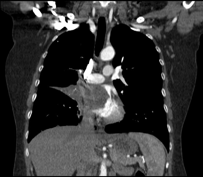 File:Adenocarcinoma of the lung (Radiopaedia 44205-47803 Coronal C+ portal venous phase 42).jpg